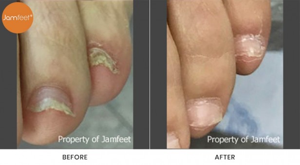 Toenail