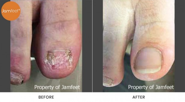 Toenail