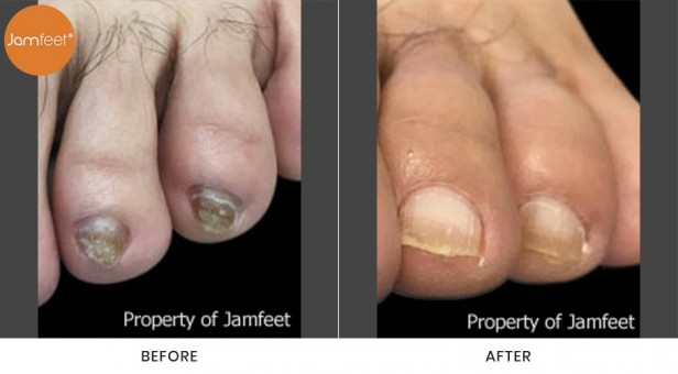 Toenail