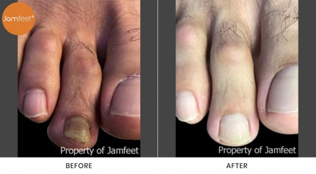Toenail
