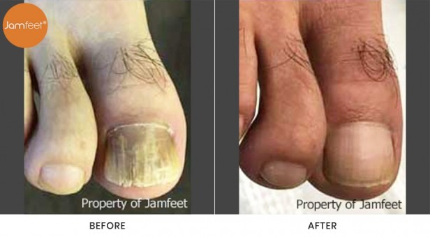 Toenail