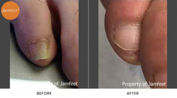 Toenail