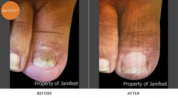 Toenail