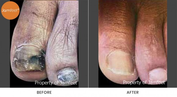 Toenail