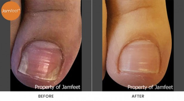 Toenail