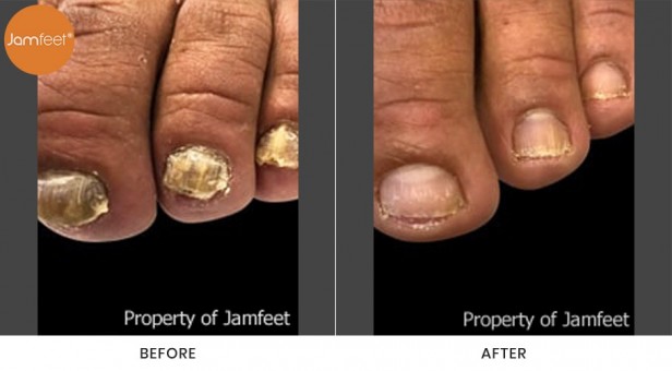Toenail