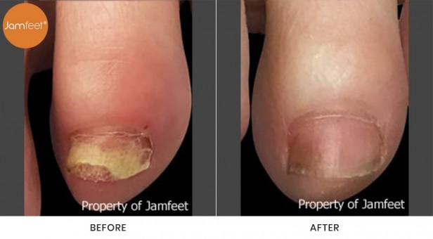 Toenail