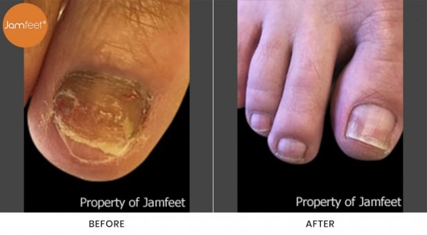 Toenail