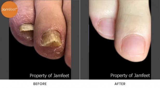Toenail