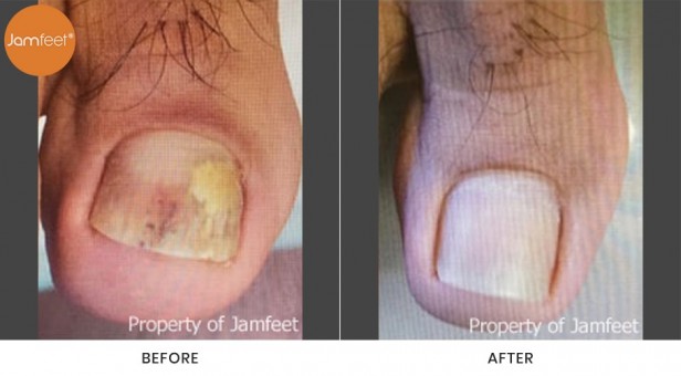 Toenail
