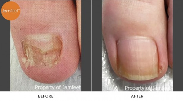 Toenail