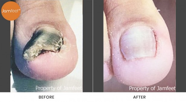 Toenail
