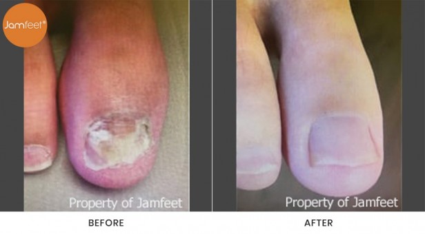 Toenail