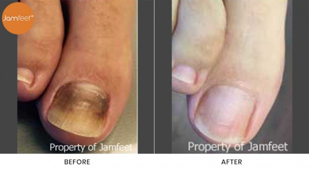 Toenail