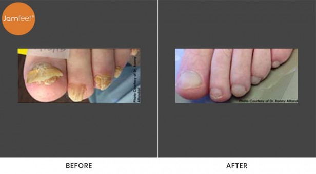Toenail