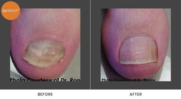Toenail