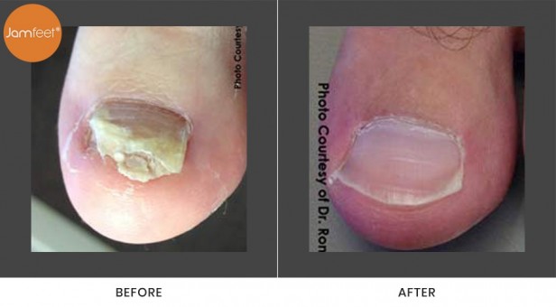 Toenail