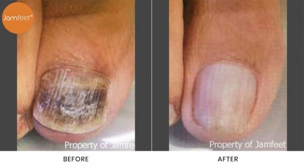 Toenail