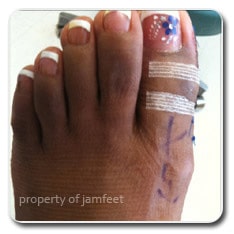 patient foot after picture