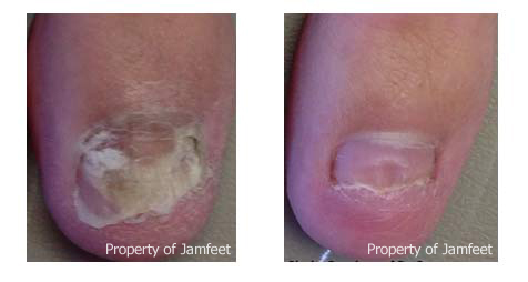 toenail fungus laser treatment