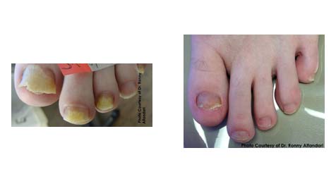 fungus treatment for nails