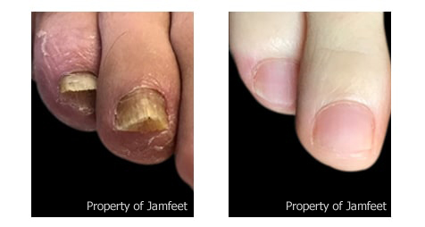 laser toenail fungus removal
