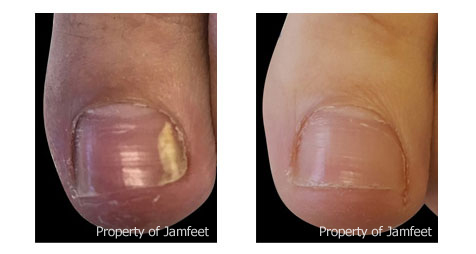 How long does it take for toe fungus to heal Before And After Toenail Photo Dr Jam Feet