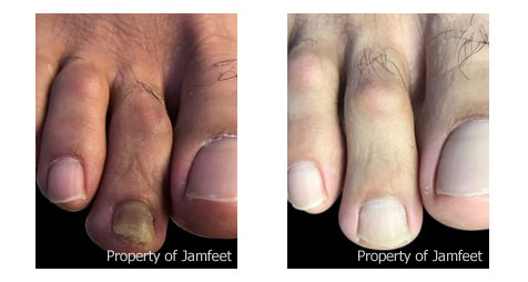 Before and After Toenail Photo | Podiatrist | Foot and Ankle Doctor