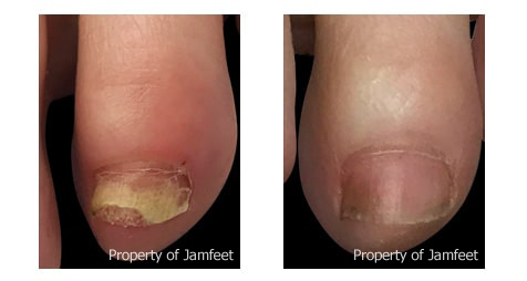 Before and After Toenail Photo | Podiatrist | Foot and Ankle Doctor