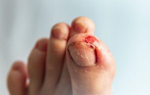 Infected wound on stubbed toe stock photo
