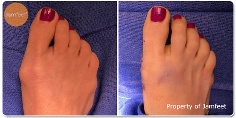 Bunion Surgery Photos Before and After of Patient 06 by Dr. Jam Feet Beverly Hills