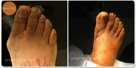 Right foot Lapidus Bunion Correction Before and After Photo of Patient 19 Dr. Jam Feet Los Angeles