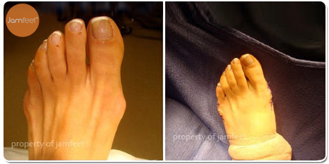 Wide Foot Cosmetic Bunion Surgery Before and After Photo of Patient 22 Dr. Jam Feet Beverly Hills