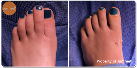 Bunionectomy Revision Photos Before and After of Patient 05 by Dr. Jam Feet Beverly Hills