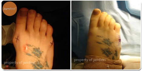 Painful Bunion Deformity After Photo of Patient 26 Dr. Jam Feet Los Angeles