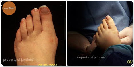 Left Foot Bunion Deformity Surgery After Photo of Patient 28 Dr. Jam Feet Los Angeles