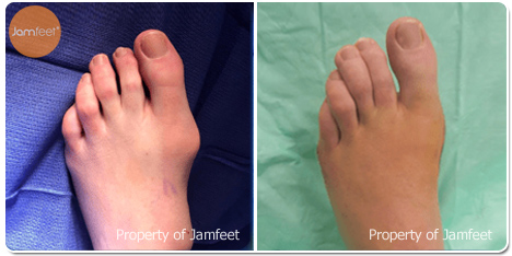Bunion Correction Left Foot Before Photo of Patient 42 Dr. Jam Feet Beverly Hills