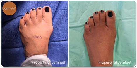 Hidden Incision Bunion Surgery Before Photo of Patient 42 Dr. Jam Feet Los Angeles