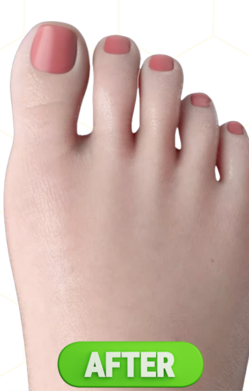 A left foot without a bunion after image