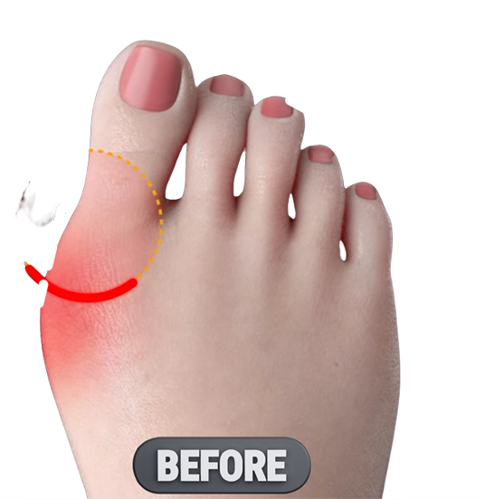 A right foot with a bunion before image