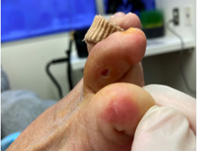 Diabetic foot after picture 1