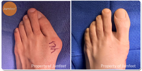 Bunion Surgery Photos Before and After of Patient 46 by Dr. Jam Feet Beverly Hills