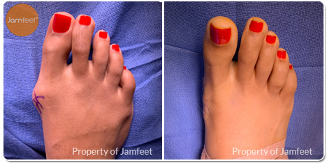Bunion Surgery Photos Before and After of Patient 47 by Dr. Jam Feet Beverly Hills