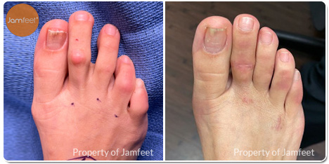 Bunion Surgery Photos Before and After of Patient 44 by Dr. Jam Feet Beverly Hills