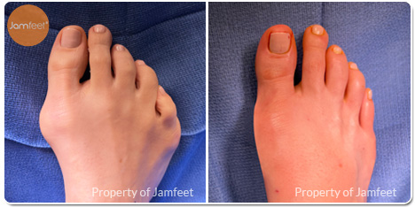 Bunion Surgery Photos Before and After of Patient 45 by Dr. Jam Feet Beverly Hills