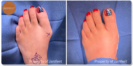 Bunion Surgery Photos Before and After of Patient 01 by Dr. Jam Feet Beverly Hills