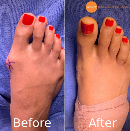 Bunion foot before and after image