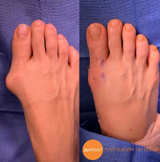 Bunion foot before and after image