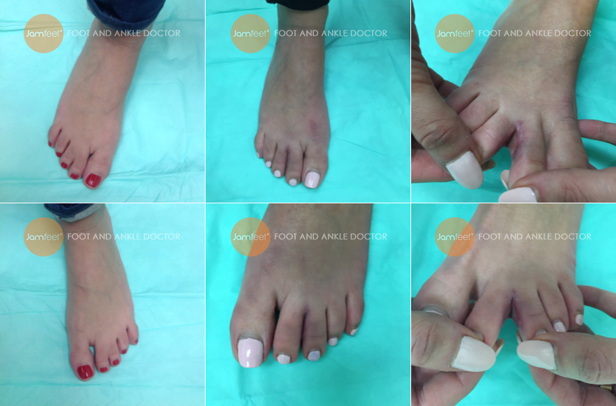 webbed toe separation surgery before & after Picture